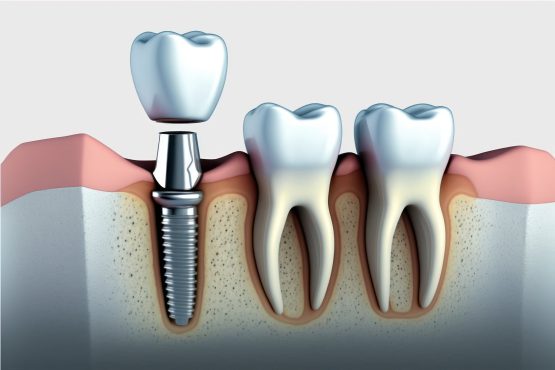 ایمپلنت اندواستیل چیست ؟