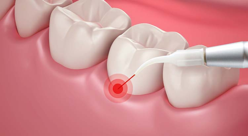 جراحی لثه با لیزر چیست ؟