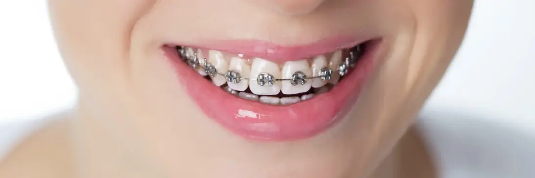 ارتودنسی دندان چه مزایایی دارد ؟
