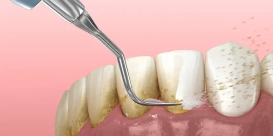 آیا جرم گیری به مینای دندان آسیب میزند؟