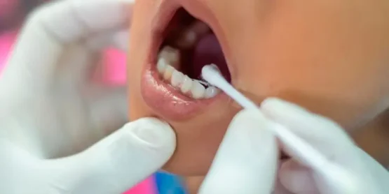 فلورایدتراپی و فواید آن برای دندان کودکان