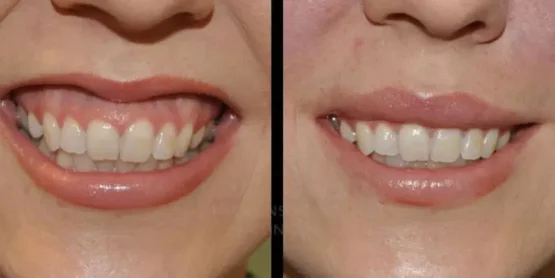 مراقبت های بعد از جراحی لثه