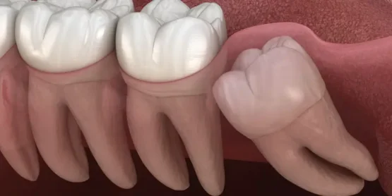 جراحی دندان عقل چه زمانی ضروری است؟
